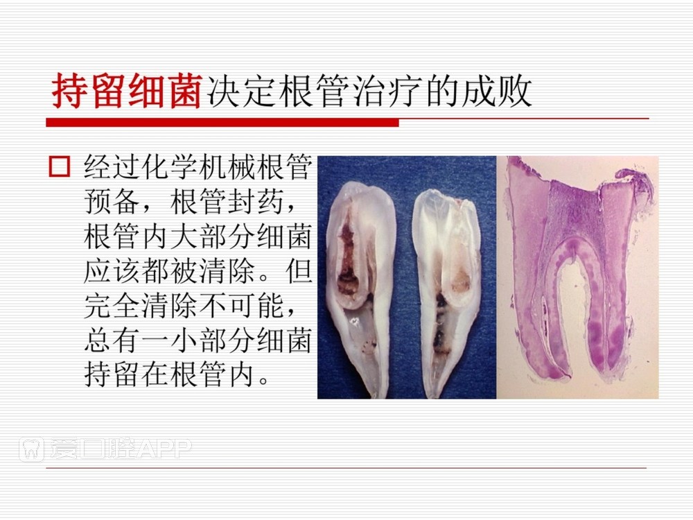 (完整版)口腔根管治疗标准化操作流程_7.jpg