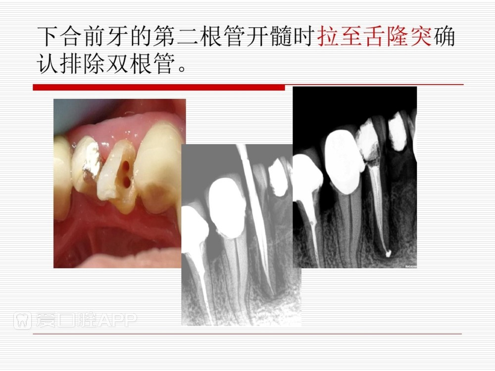 (完整版)口腔根管治疗标准化操作流程_24.jpg