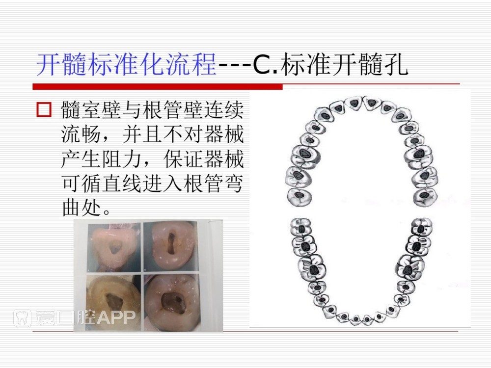(完整版)口腔根管治疗标准化操作流程_23.jpg