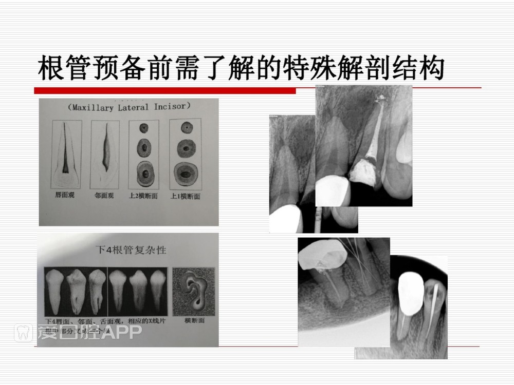 (完整版)口腔根管治疗标准化操作流程_28.jpg