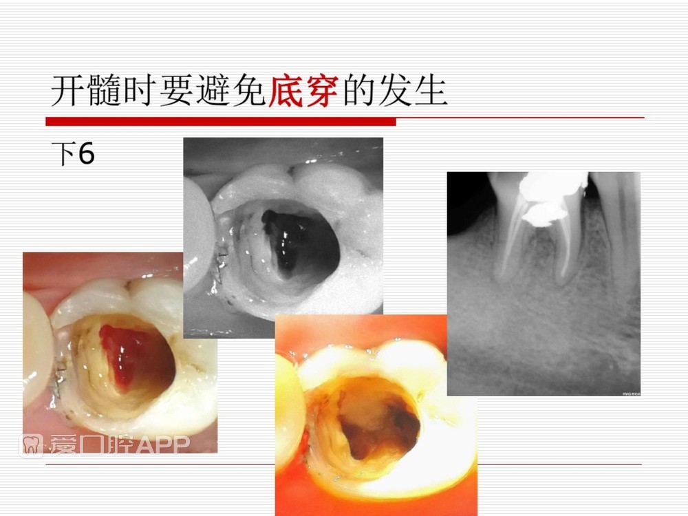 (完整版)口腔根管治疗标准化操作流程_26.jpg