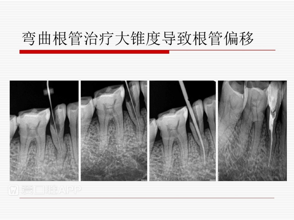 (完整版)口腔根管治疗标准化操作流程_40.jpg