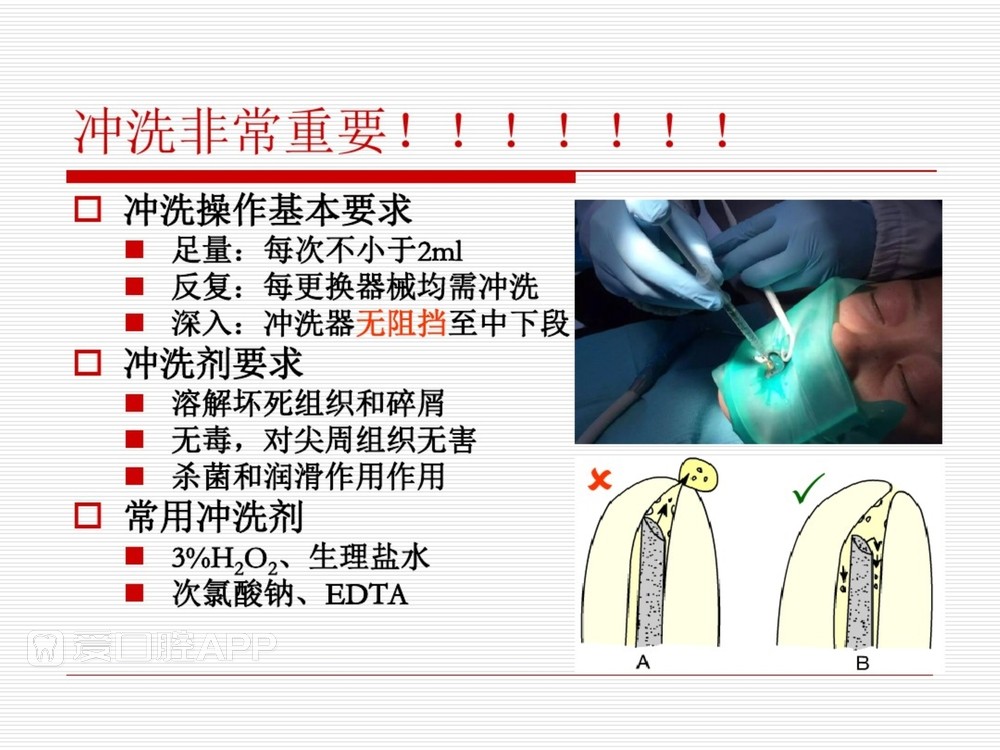 (完整版)口腔根管治疗标准化操作流程_47.jpg