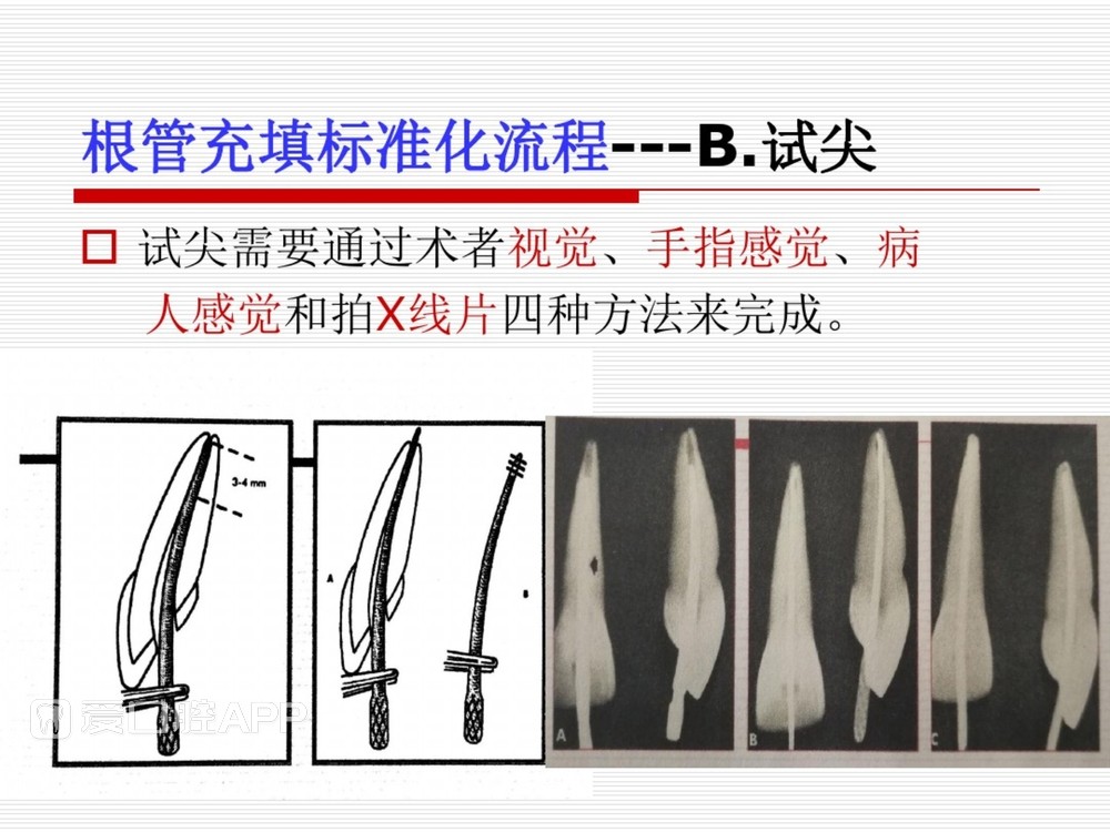 (完整版)口腔根管治疗标准化操作流程_61.jpg