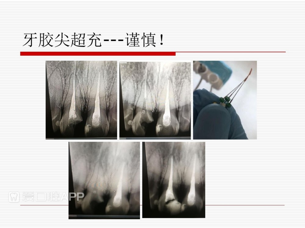 (完整版)口腔根管治疗标准化操作流程_66.jpg