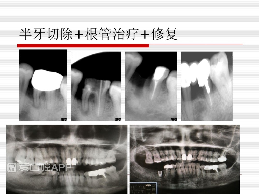 (完整版)口腔根管治疗标准化操作流程_67.jpg