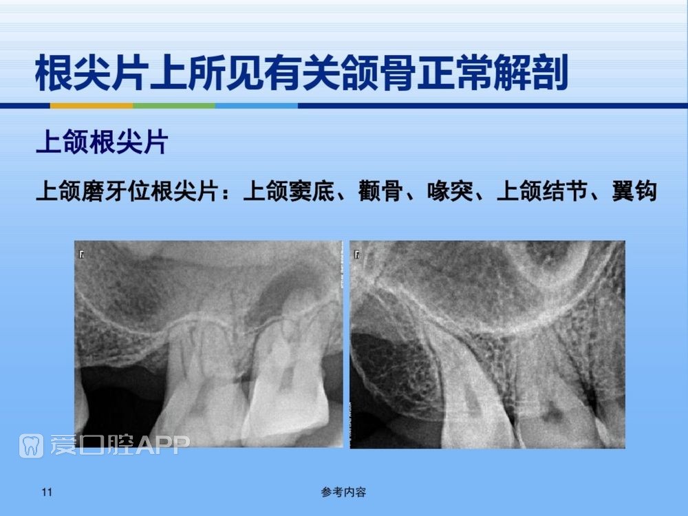 牙体牙周正常解剖及常见病X线表现(内容丰富)_11.jpg