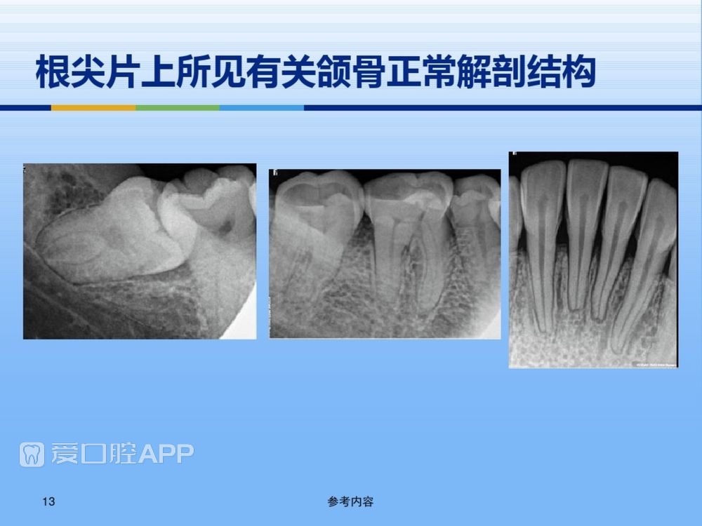 牙体牙周正常解剖及常见病X线表现(内容丰富)_13.jpg