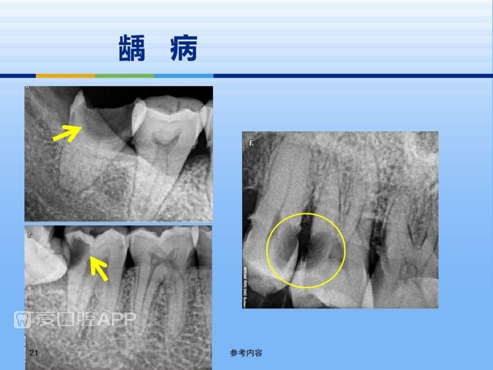 牙体牙周正常解剖及常见病X线表现(内容丰富)_21.jpg