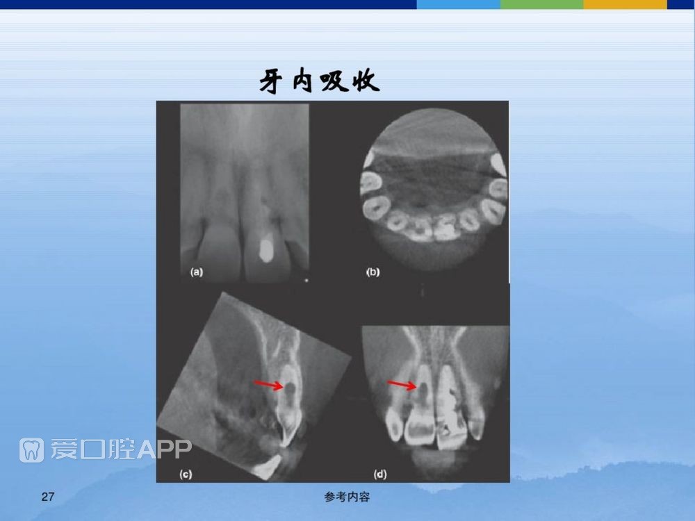 牙体牙周正常解剖及常见病X线表现(内容丰富)_27.jpg