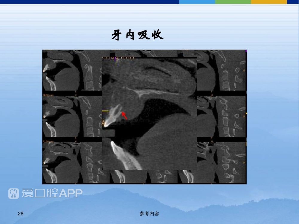 牙体牙周正常解剖及常见病X线表现(内容丰富)_28.jpg