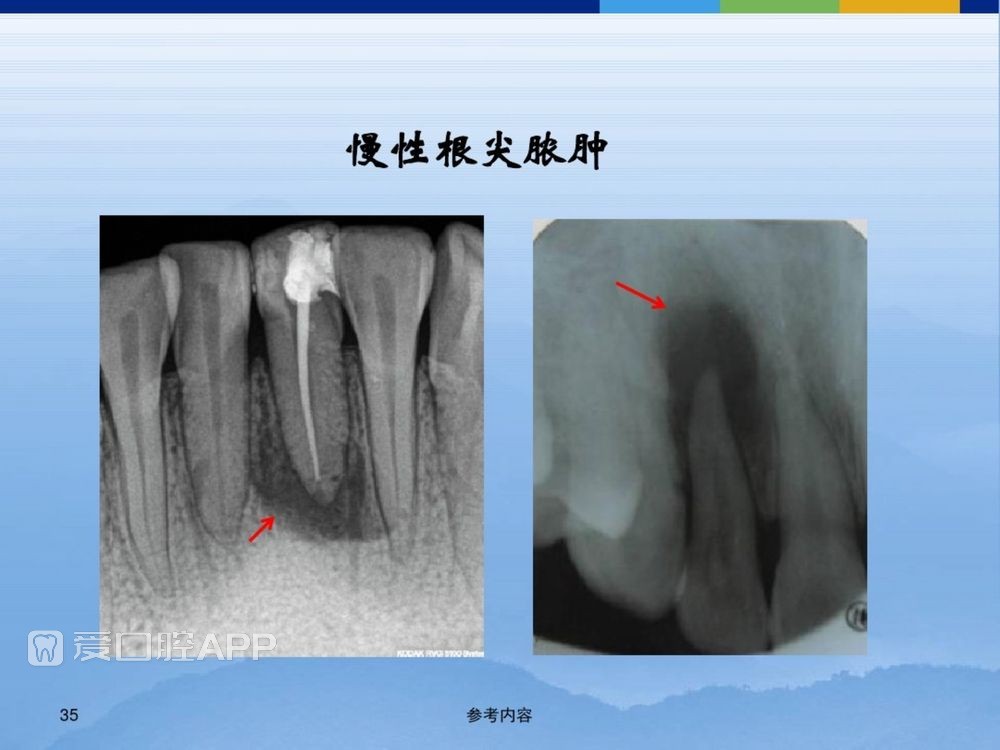 牙体牙周正常解剖及常见病X线表现(内容丰富)_35.jpg