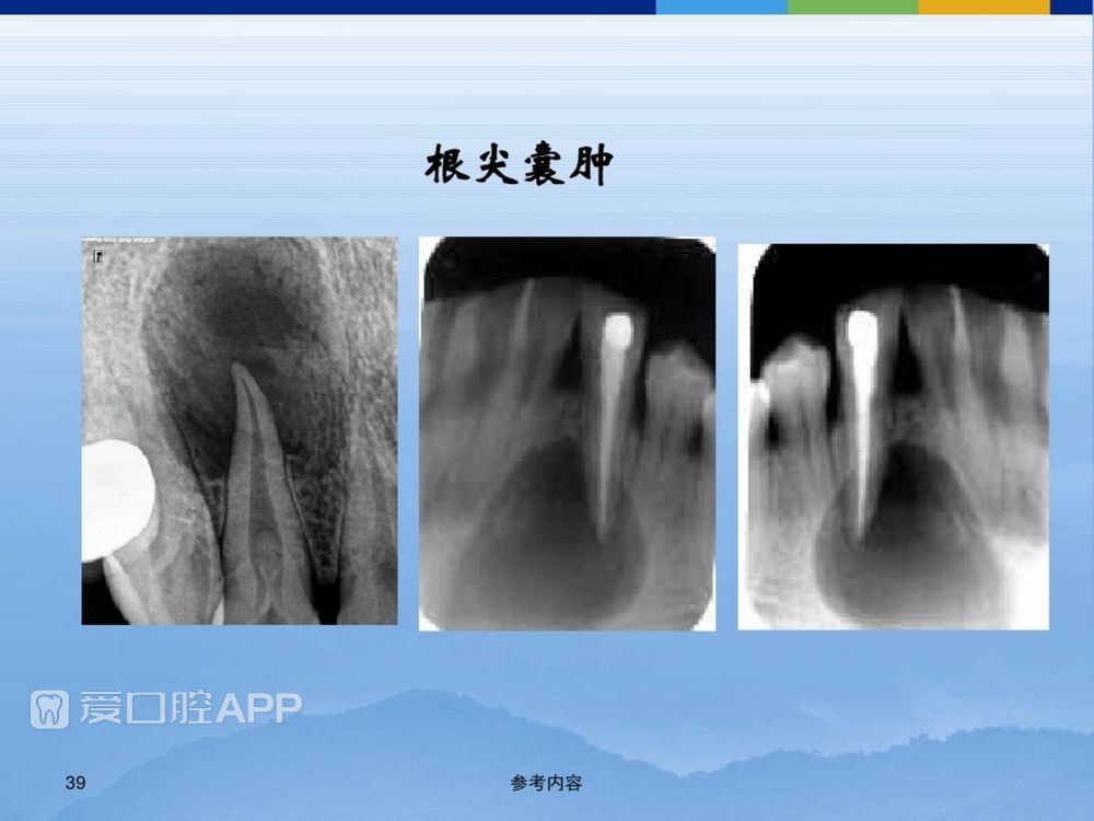 牙体牙周正常解剖及常见病X线表现(内容丰富)_39.jpg