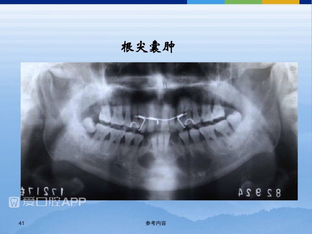 牙体牙周正常解剖及常见病X线表现(内容丰富)_41.jpg