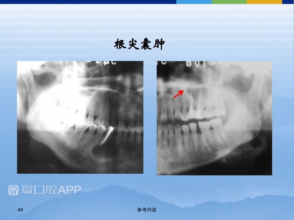 牙体牙周正常解剖及常见病X线表现(内容丰富)_40.jpg