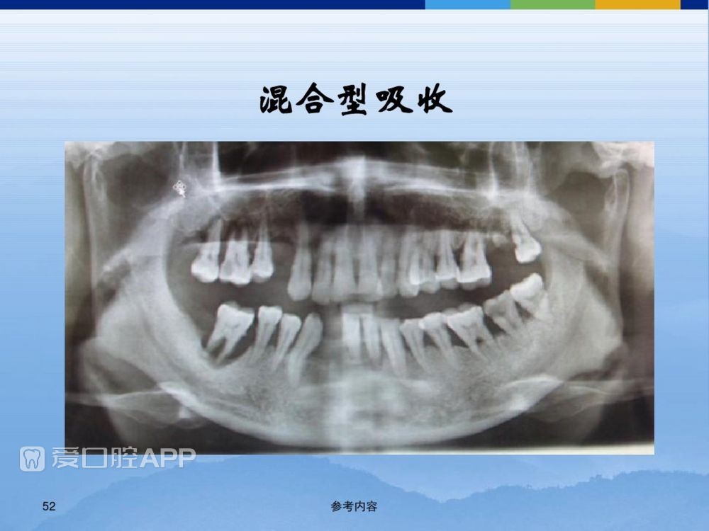 牙体牙周正常解剖及常见病X线表现(内容丰富)_52.jpg