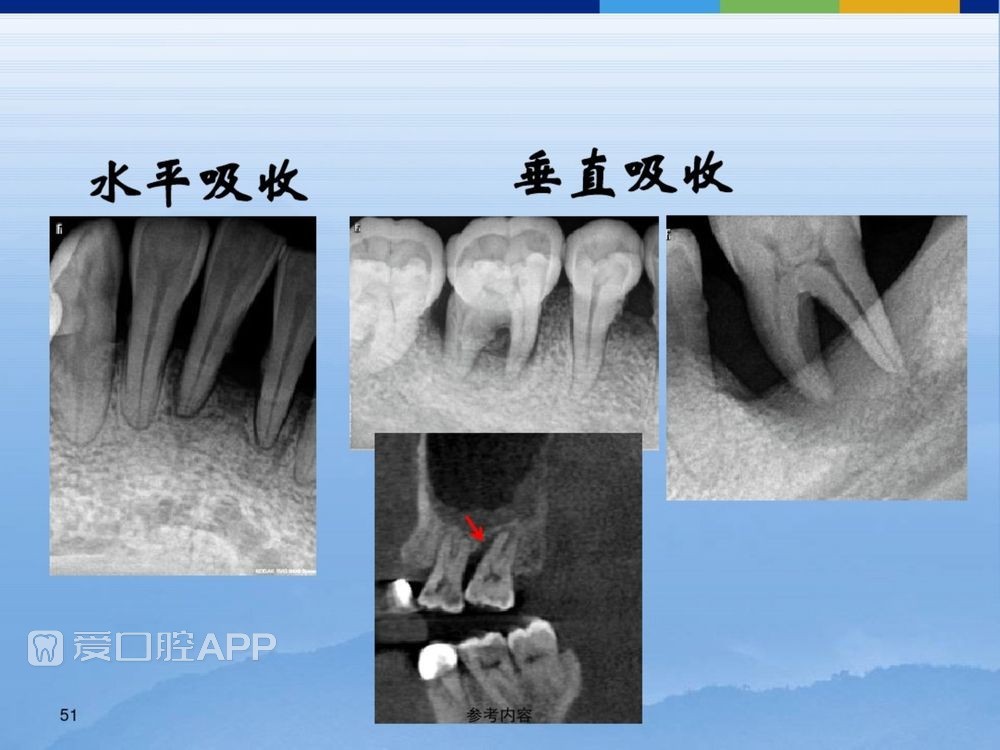 牙体牙周正常解剖及常见病X线表现(内容丰富)_51.jpg