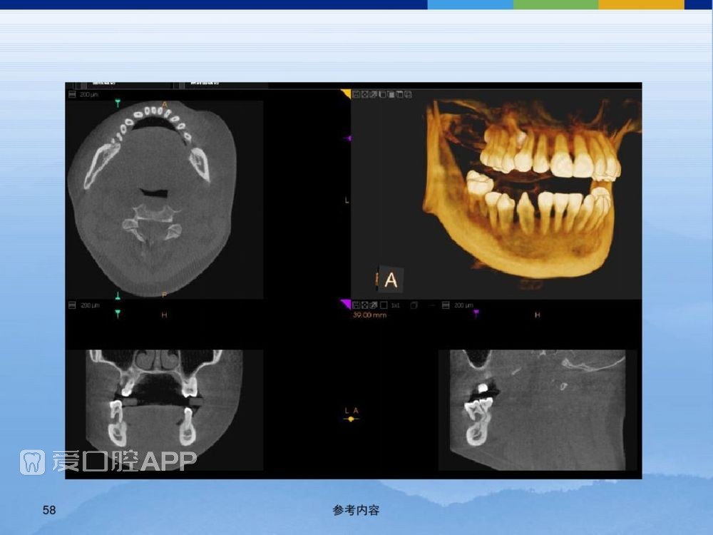 牙体牙周正常解剖及常见病X线表现(内容丰富)_58.jpg