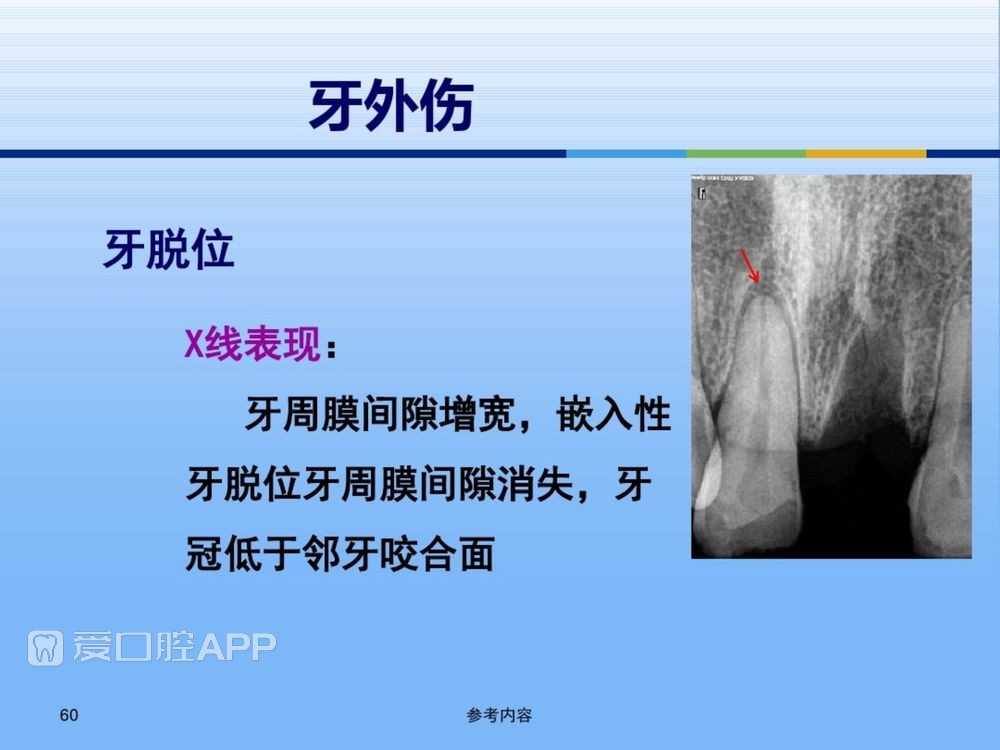 牙体牙周正常解剖及常见病X线表现(内容丰富)_60.jpg