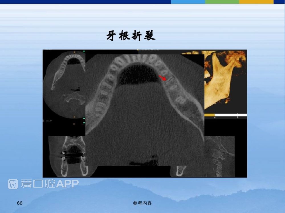 牙体牙周正常解剖及常见病X线表现(内容丰富)_66.jpg