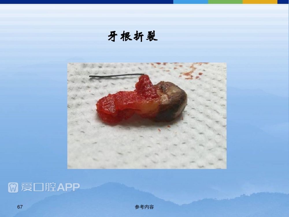 牙体牙周正常解剖及常见病X线表现(内容丰富)_67.jpg