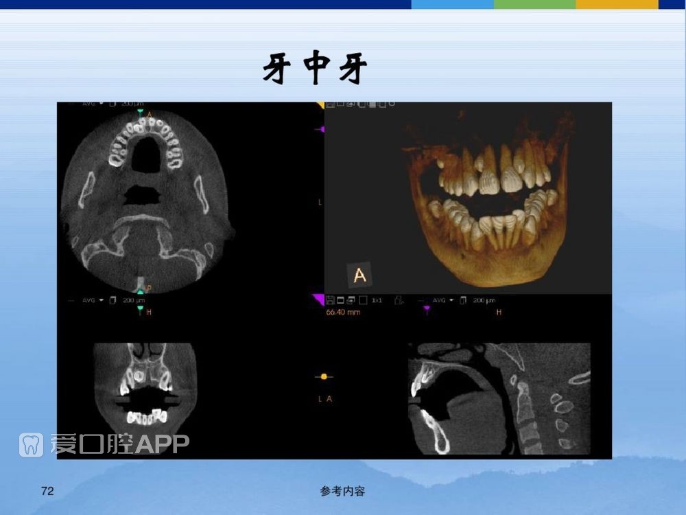 牙体牙周正常解剖及常见病X线表现(内容丰富)_72.jpg