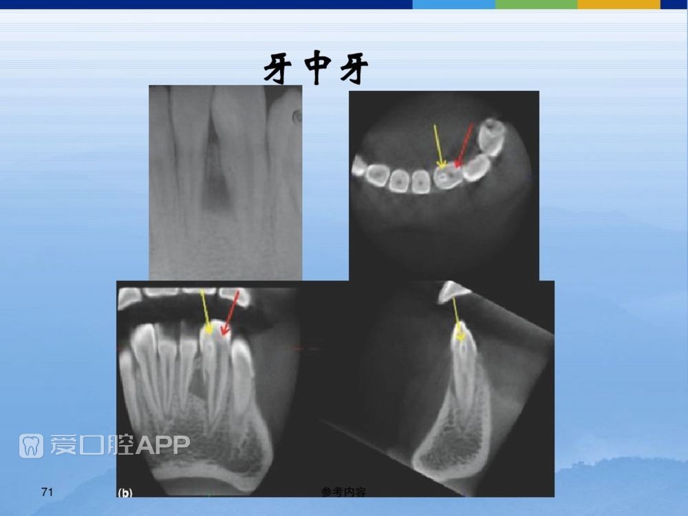 牙体牙周正常解剖及常见病X线表现(内容丰富)_71.jpg