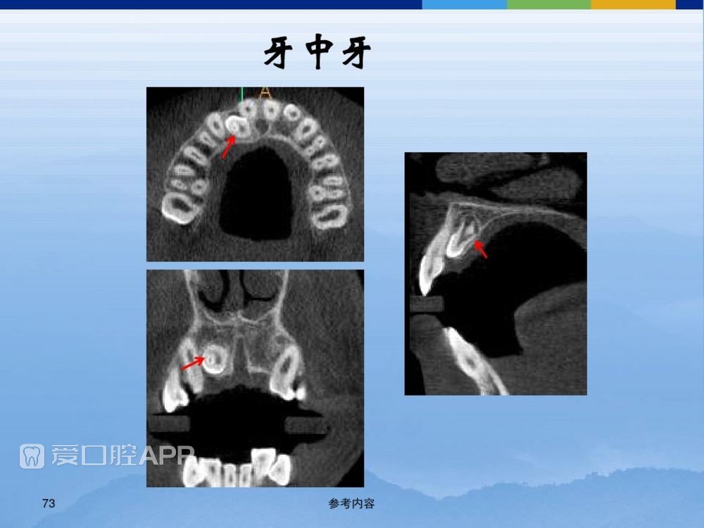 牙体牙周正常解剖及常见病X线表现(内容丰富)_73.jpg