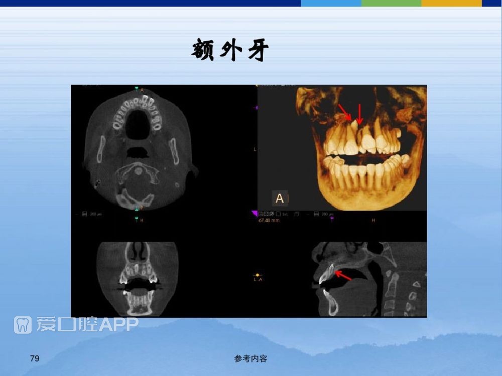 牙体牙周正常解剖及常见病X线表现(内容丰富)_79.jpg