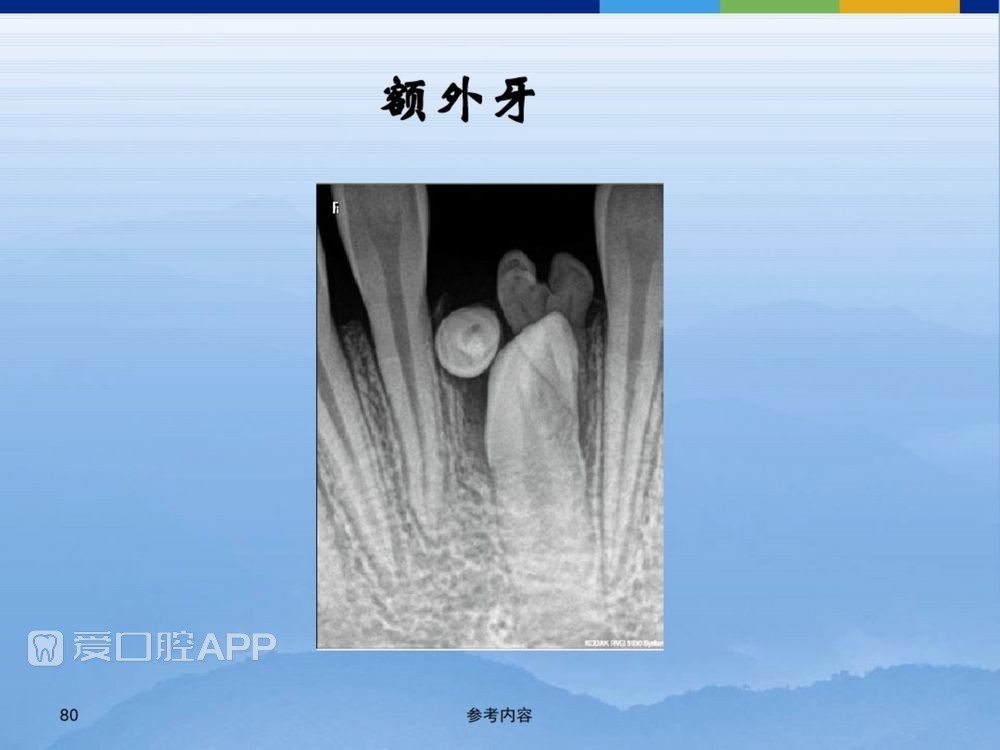 牙体牙周正常解剖及常见病X线表现(内容丰富)_80.jpg