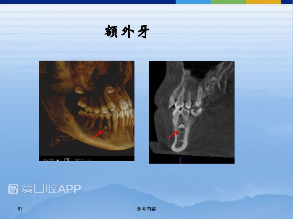 牙体牙周正常解剖及常见病X线表现(内容丰富)_81.jpg