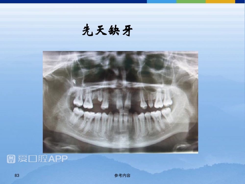 牙体牙周正常解剖及常见病X线表现(内容丰富)_83.jpg