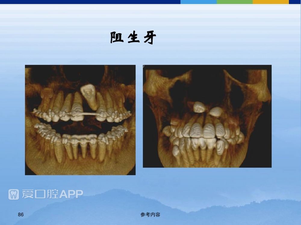 牙体牙周正常解剖及常见病X线表现(内容丰富)_86.jpg