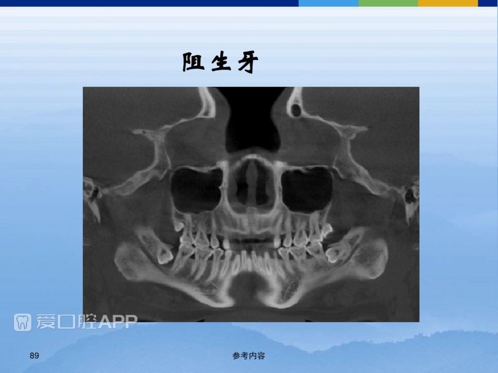 牙体牙周正常解剖及常见病X线表现(内容丰富)_89.jpg
