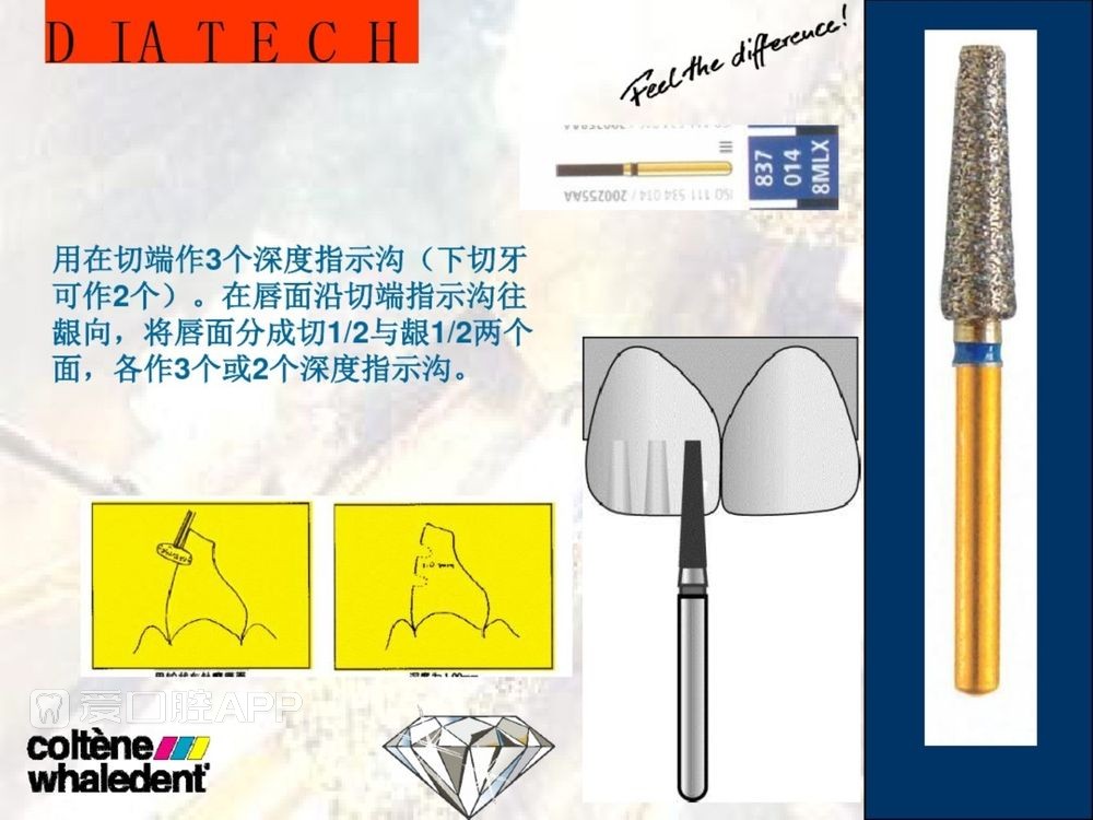 牙体预备和精确取模型 (5).jpg