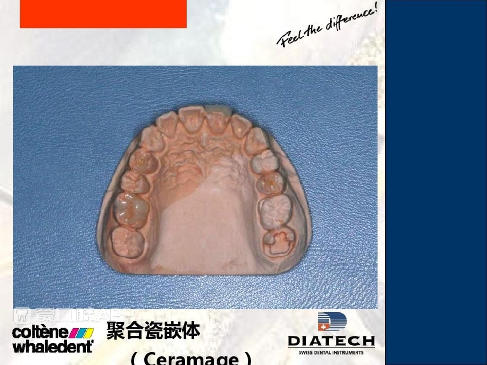牙体预备和精确取模型 (47).jpg