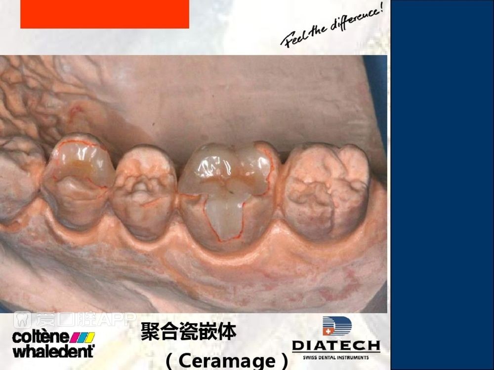 牙体预备和精确取模型 (49).jpg
