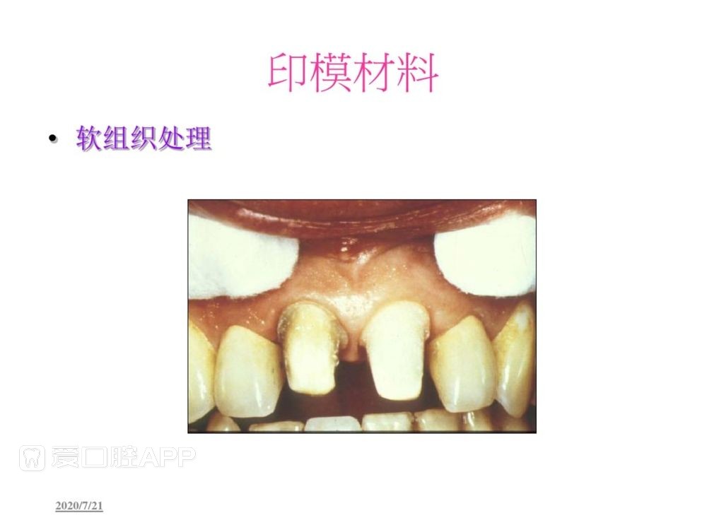 牙体预备和精确取模型 (58).jpg