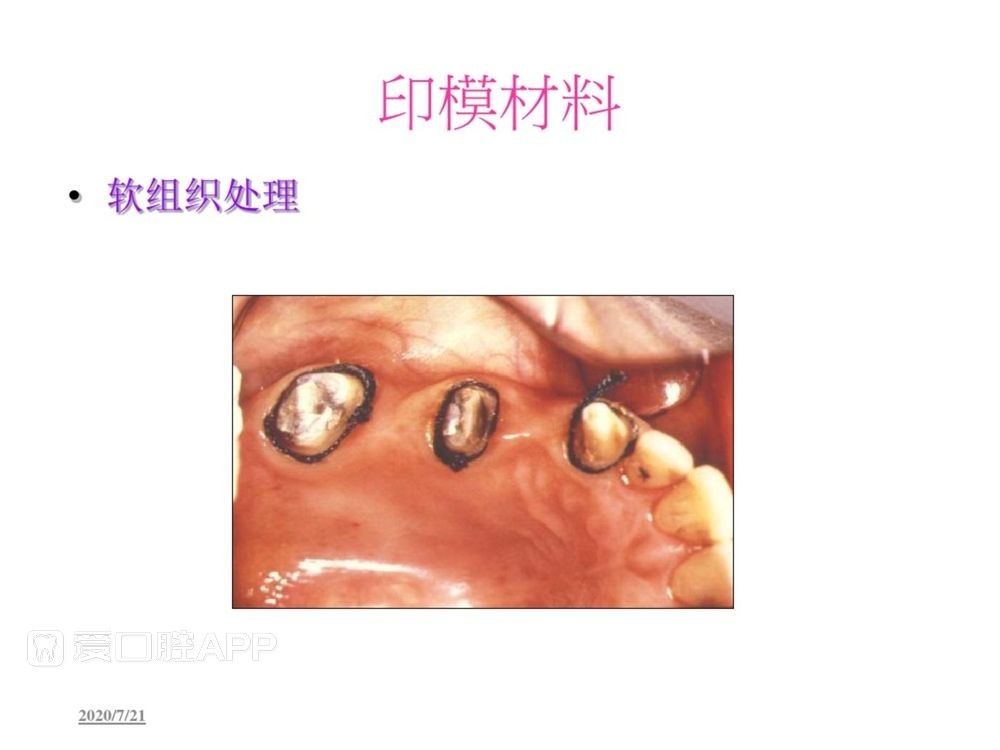牙体预备和精确取模型 (59).jpg