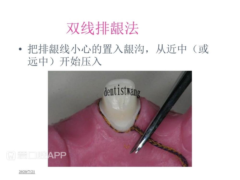 牙体预备和精确取模型 (81).jpg