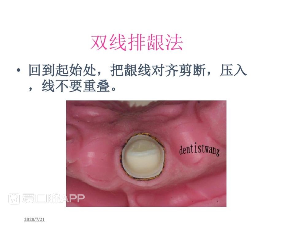 牙体预备和精确取模型 (83).jpg