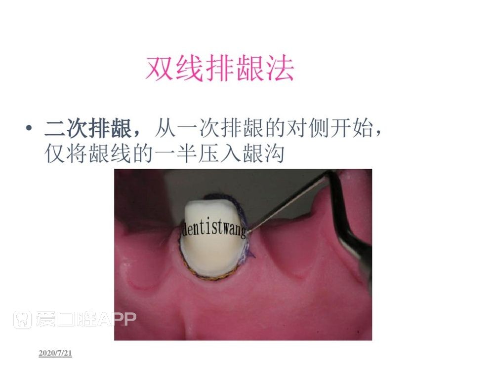 牙体预备和精确取模型 (84).jpg