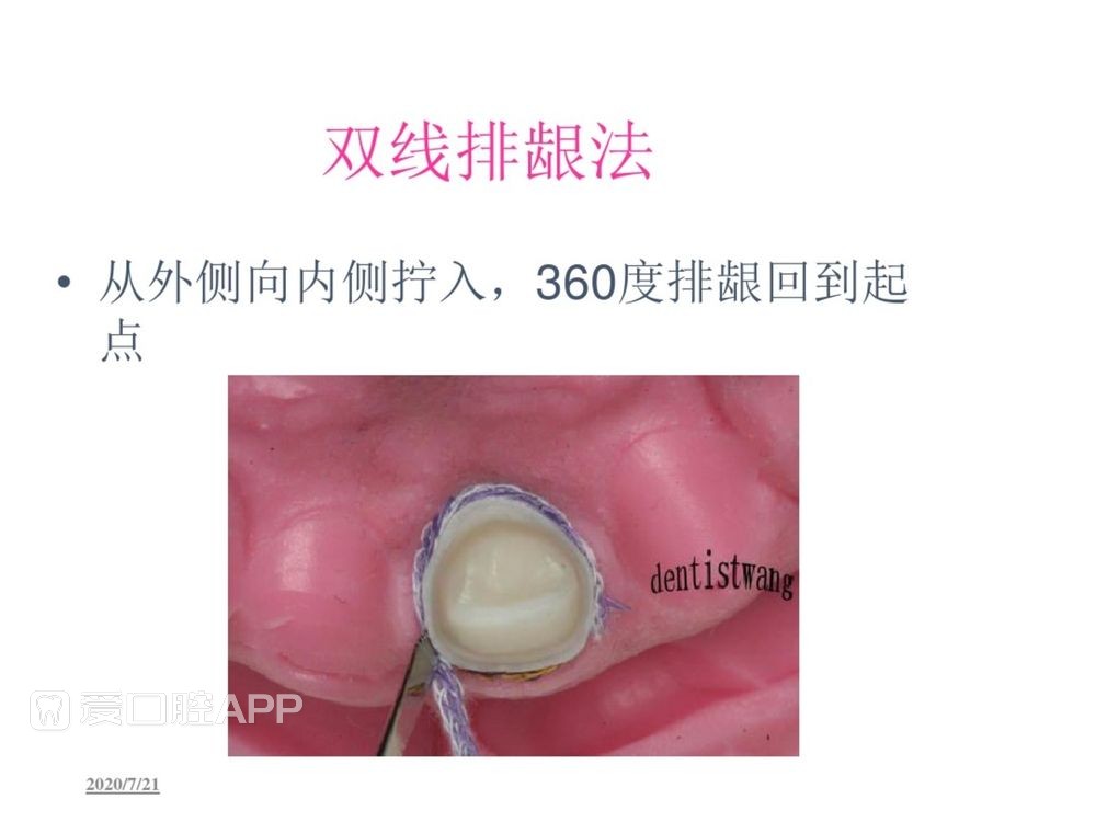 牙体预备和精确取模型 (85).jpg