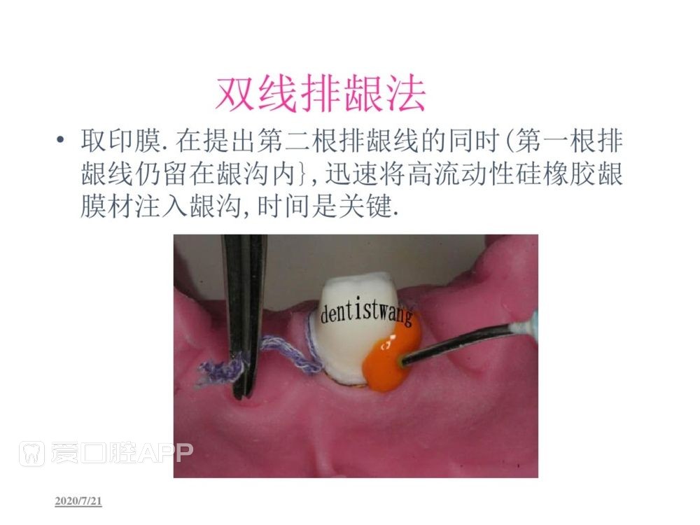 牙体预备和精确取模型 (87).jpg