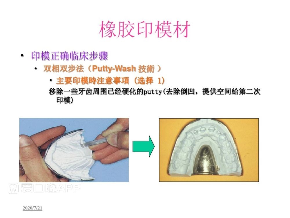 牙体预备和精确取模型 (107).jpg