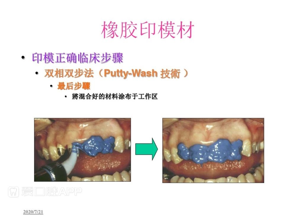 牙体预备和精确取模型 (113).jpg