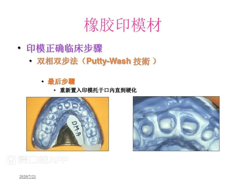 牙体预备和精确取模型 (115).jpg