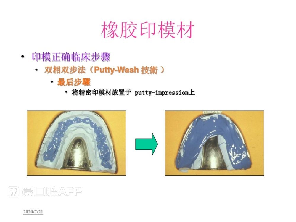 牙体预备和精确取模型 (114).jpg