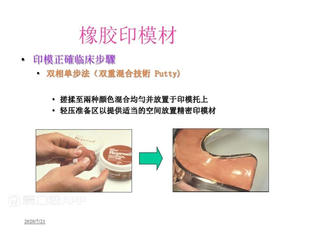 牙体预备和精确取模型 (117).jpg