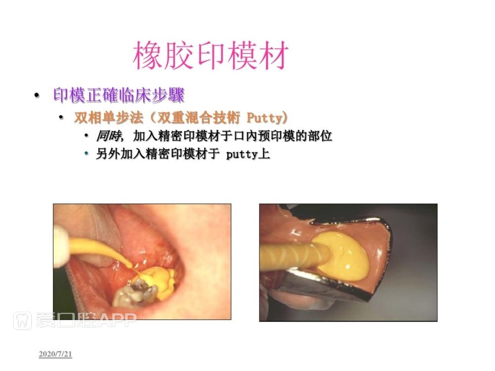 牙体预备和精确取模型 (118).jpg